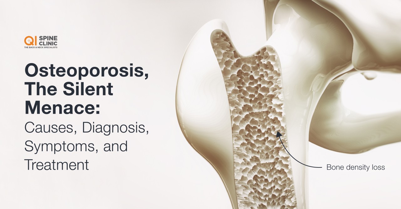 Understanding Osteoporosis A Comprehensive Guide Madican